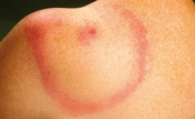 Ziekte van Lyme Erythema Migrans Ziekte van Lyme Erythema Migrans