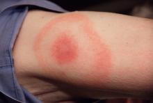 NB Lyme Eythema migrans Tekenbeet. Rode kring op huid